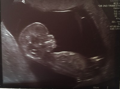 1st scan pic - 13 weeks pregnant