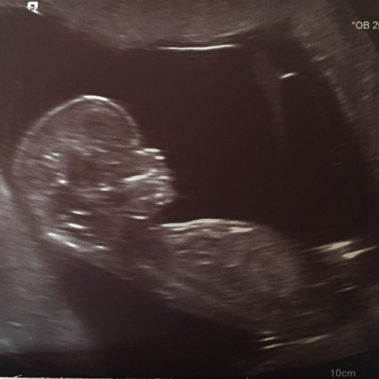 1st scan pic - 13 weeks pregnant