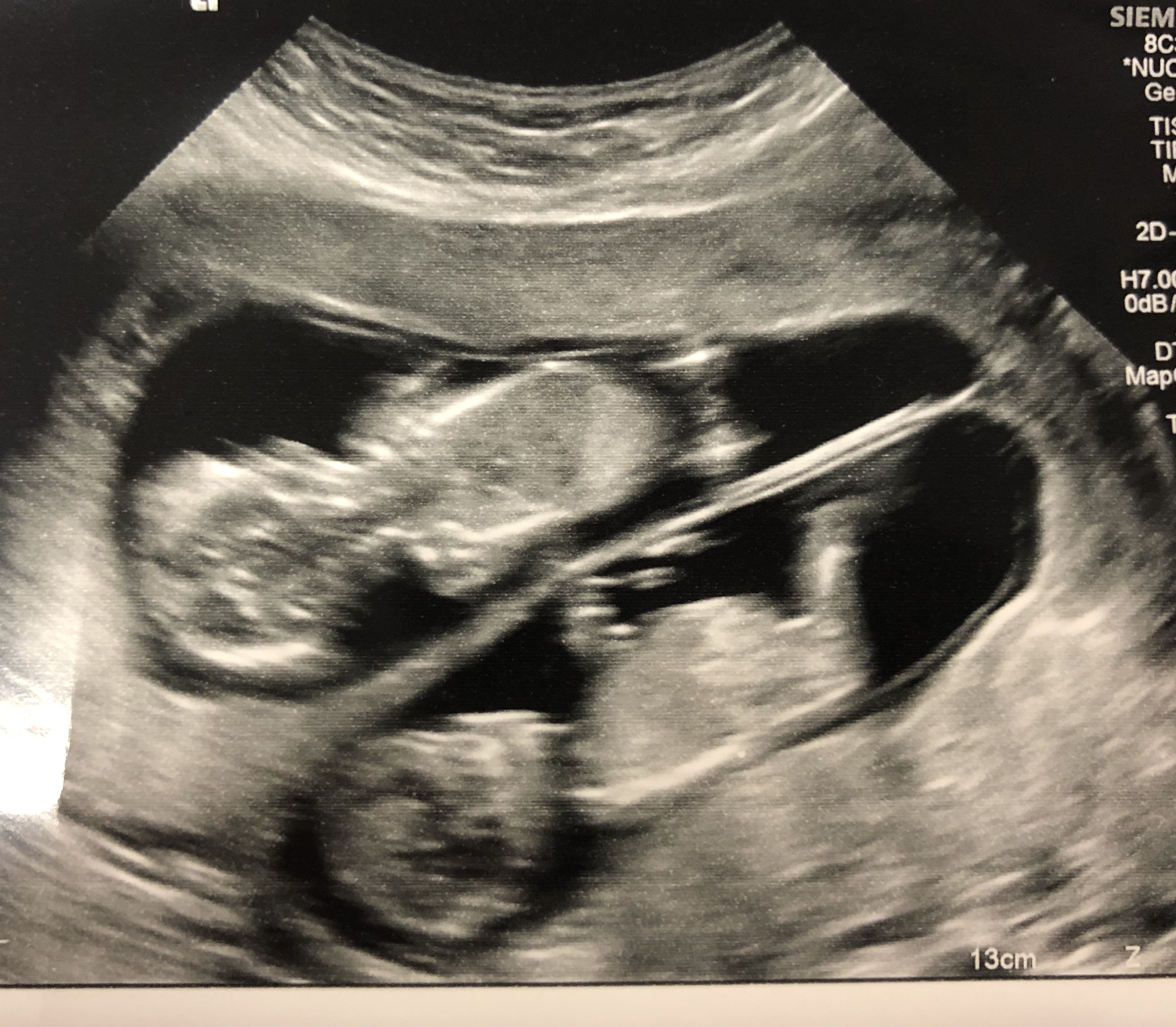 Twin pregnancy scan